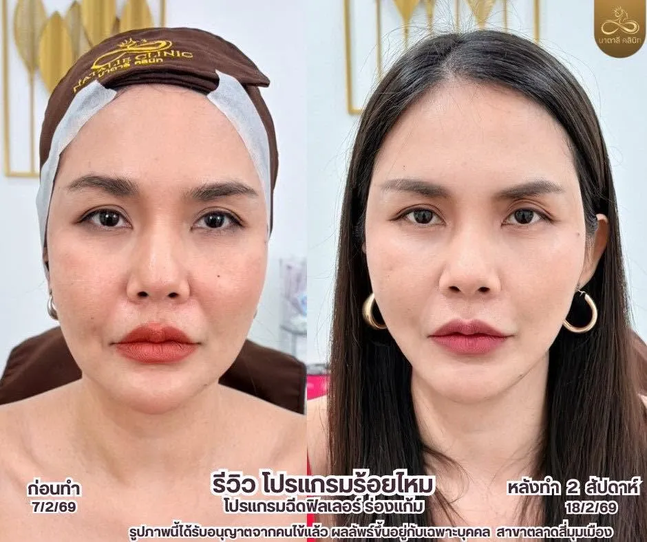 ร้อยไหม + ฟิลเลอร์